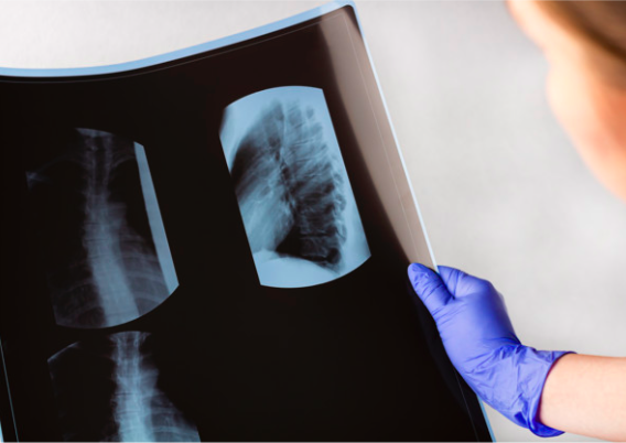 Osteolysis