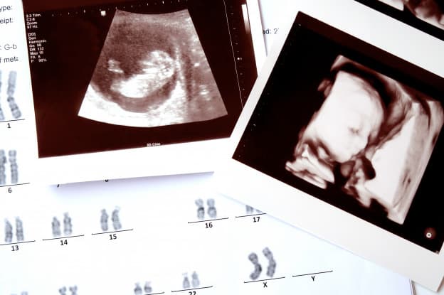 First Trimester Screening Test