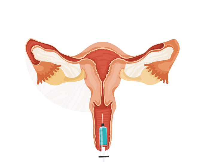 Intrauterin İnseminayon (Vaccination)